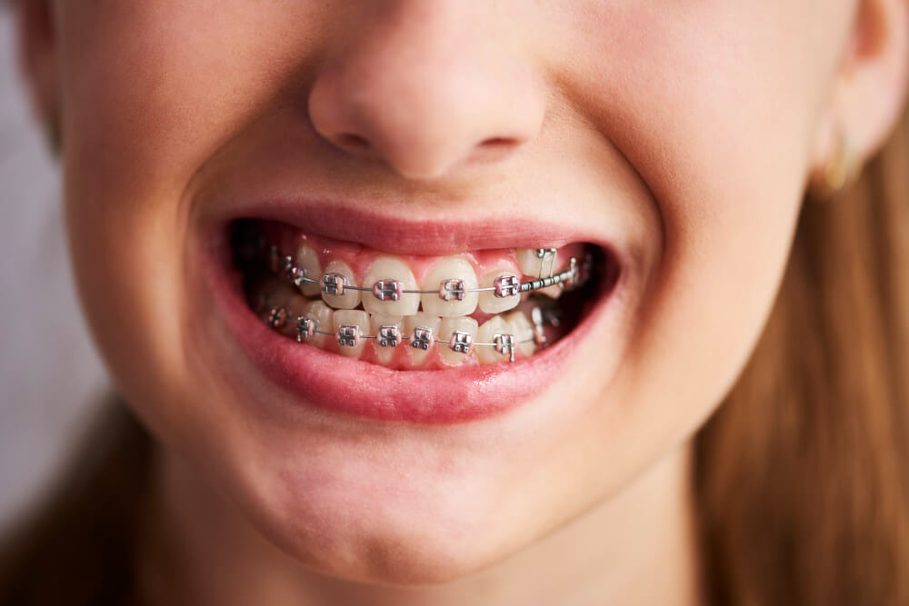 Aparelho dentário dentista tatuapé