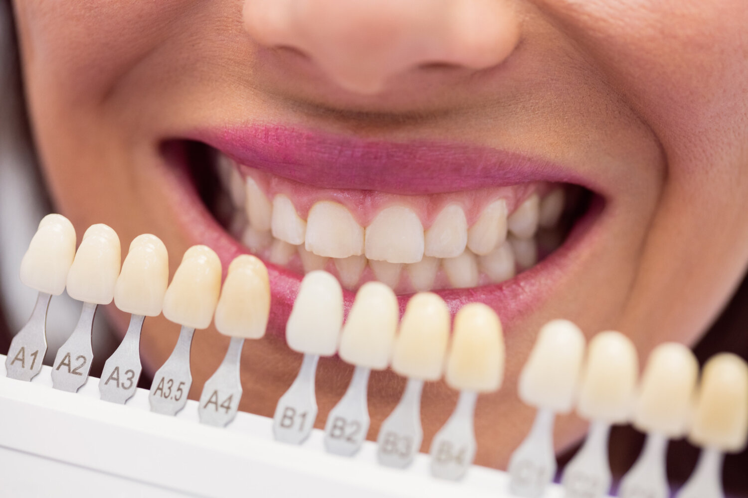 Clareamento Dentário Tatuapé